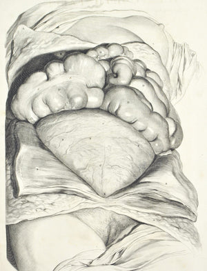 1698 - 1750 Postmortem Autopsy Female Body Internal Organs Engraved Print